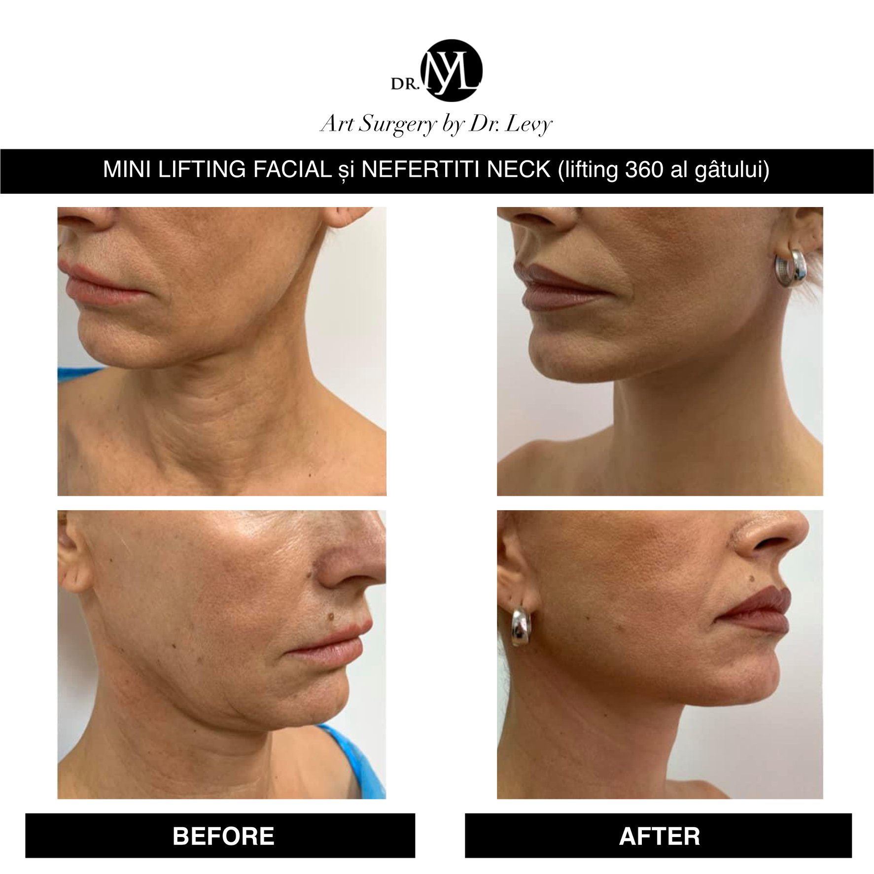 Lifting Facial - Pret si Recomandari | Dr. Eugen Turcu